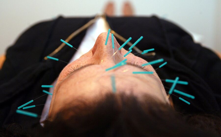 Medicina alternativa acupunctura