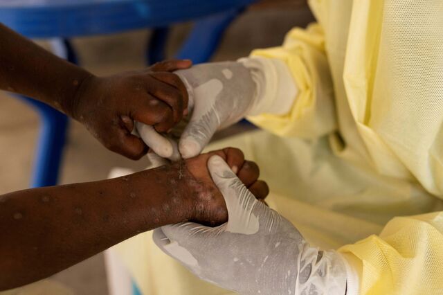 União Europeia sem controlos fronteiriços para Mpox